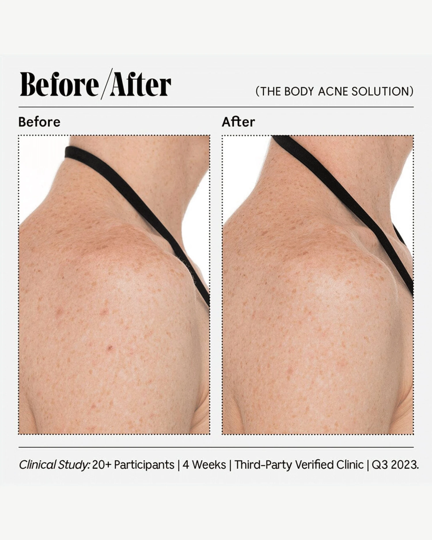 The Body Acne Solution - Image 3