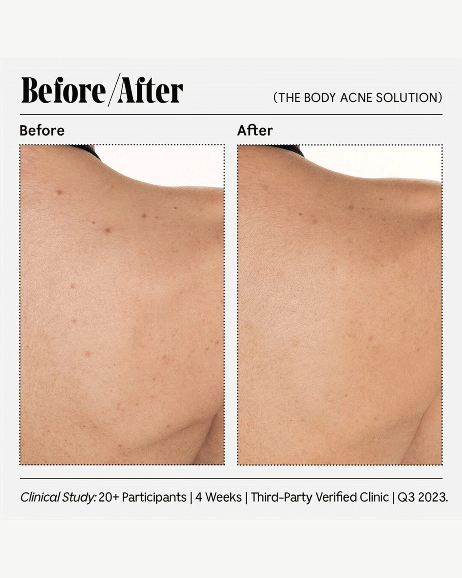 The Body Acne Solution - Image 2