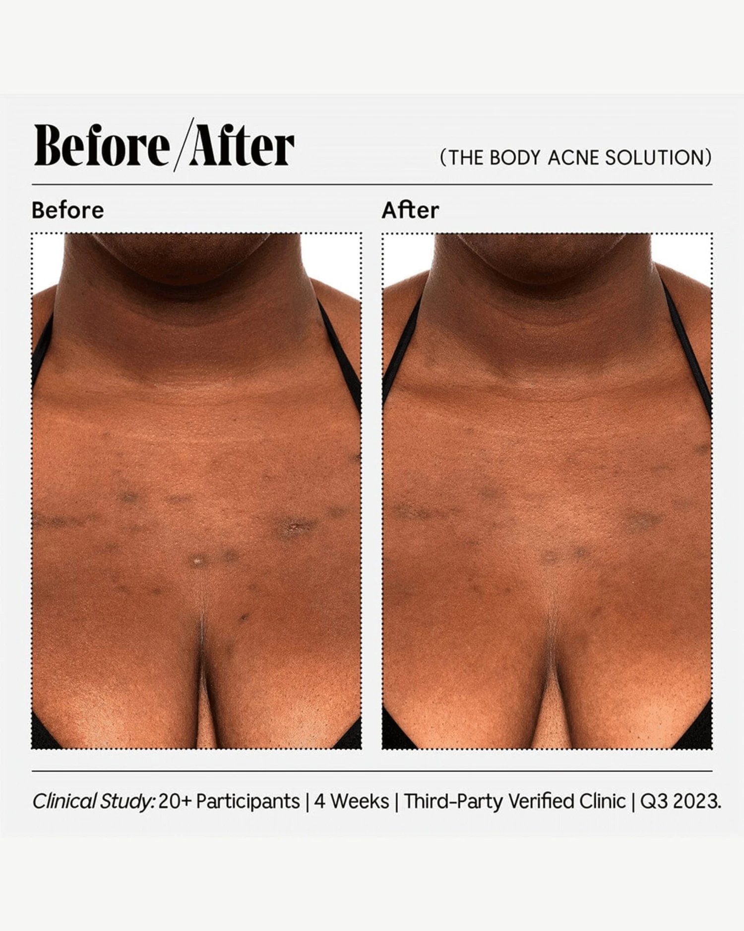The Body Acne Solution - Image 4
