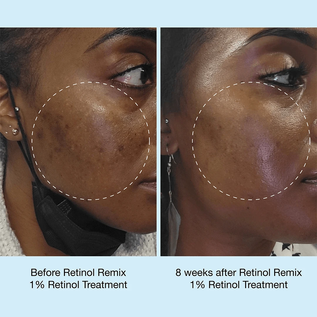 Retinol Remix 1% Retinol Treatment - Image 3