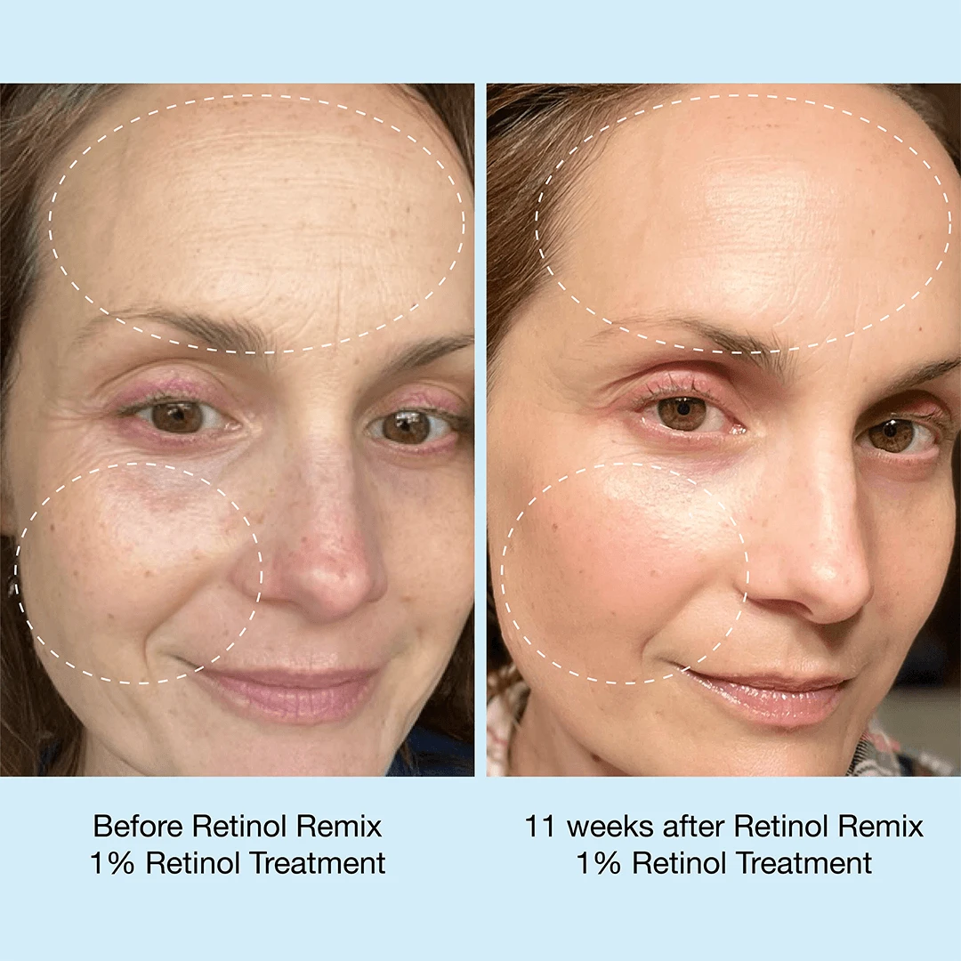 Retinol Remix 1% Retinol Treatment - Image 4